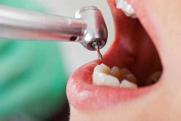 Best Knocked-Out Tooth Emergency  in Horizon City, TX